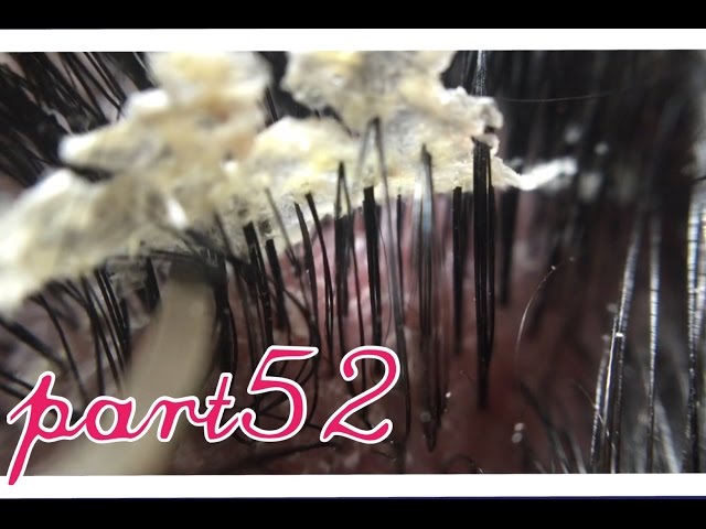 フケ Part52 巨大です 毛穴たっぷりです 満足です Big Dandruff52 Youtube