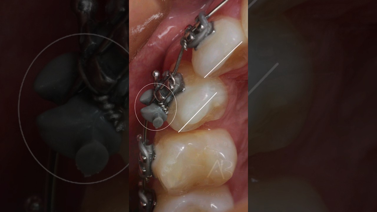 Uso de aditamentos durante el tratamiento de ortodoncia 