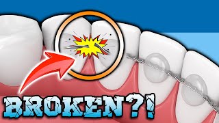 A Broken Permanent Retainer Now What? Premier Orthodontics