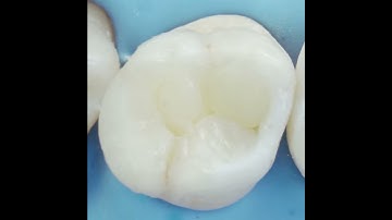 Class II Solution Capping | Dentsply Sirona