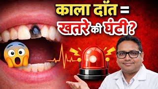 काला दाँत = खतरे की घंटी? | दाँत काला क्यों पड़ता है? | Black Tooth Causes & Treatment