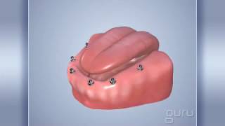 Покрывные Протезыen - Protezist