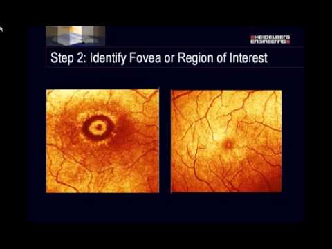 Preparing Reports: Follow-Up Imaging & Retinal Mapping with the HRT