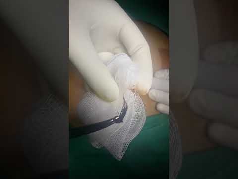 Draining a Pilonidal Cyst on the Gluteal Cleft - Max Poling PA-C