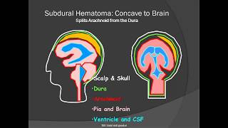 Subdural Hematoma Sdh