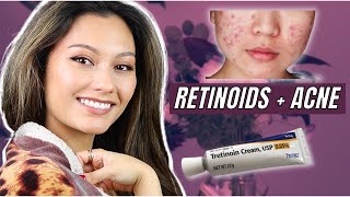 ?  All About RETINOIDS for ACNE