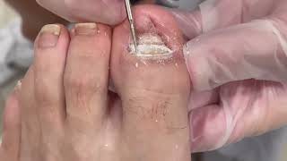 Soccer Injury Causes Thick + Dark Rams Horn Toenail