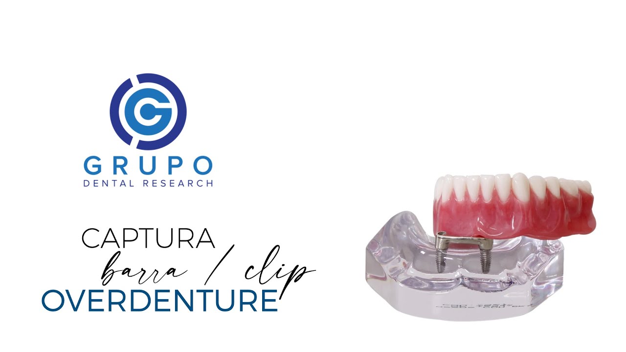 🦷  Como capturar o encaixe BARRA/CLIP da OVERDENTURE sobre implantes? Passo a passo clínico completo