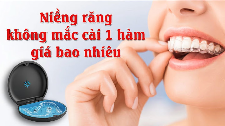 Niềng răng 1 hàm trên giá bao nhiêu