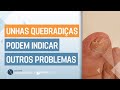 Unhas QUEBRADIÇAS podem indicar outros PROBLEMAS