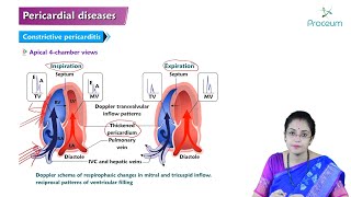 Pericardial Disease (Hindi) : Etiology, Clinical Features, Diagnosis, Treatment, and Complications