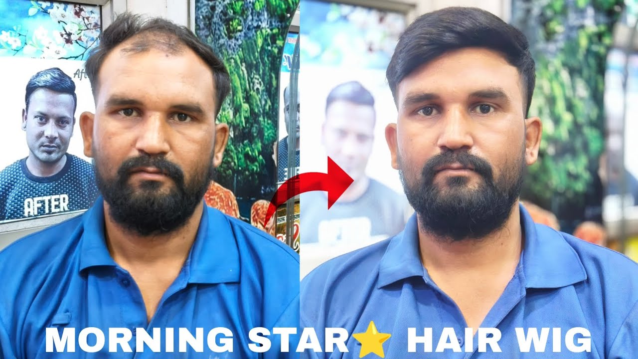 Free style hair patch fixing centre in Agra mathura mo.7037489714, Hathras aligarh bharatpur dholpur