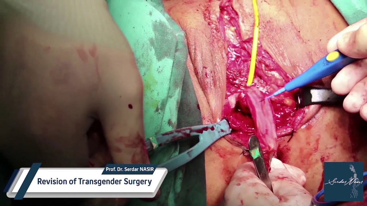 How To Transgender Surgery Video – Sdlgbtn