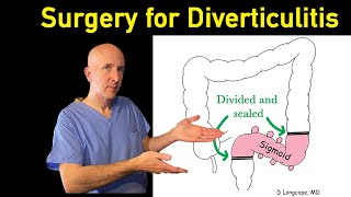 Surgery for diverticulitis: In-depth explanation