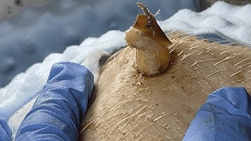 [ASMR] Huge Armpit Blackhead Extraction – Dr. Pimple Popper’s Most Satisfying Removal Ever! 0755