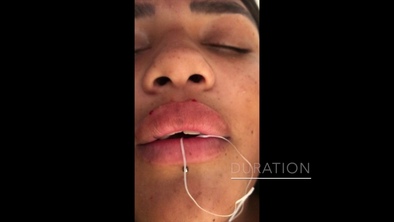 Training in Lip Fillers YouTube