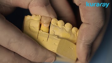 Dual cure cementation with PFM crown by 