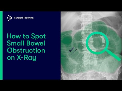 Small Bowel Obstruction | How Do We Diagnose It On Abdominal X-Ray