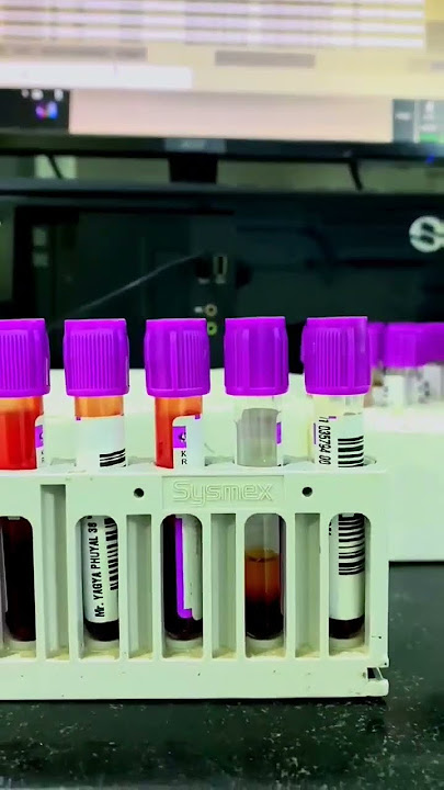 CBC Blood Test (Complete Blood Count) by Sysmex XN-1000™ 