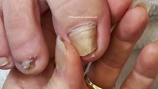 Pincer Toenail Big Toenail Transformations