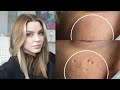 Esthetician Discusses How To Eliminate Pitted Acne Scars