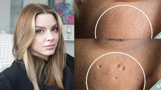 Esthetician Discusses How To Eliminate Pitted Acne Scars