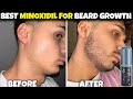 Can Tugain 5 Make You Grow Beard Faster? Real Test | Best Minoxidil For Beard Growth | Minoxidil 5