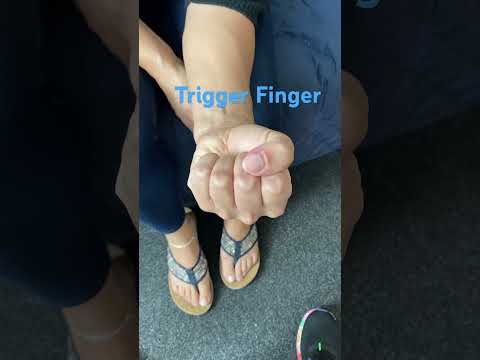 What Trigger Finger ACTUALLY Looks Like