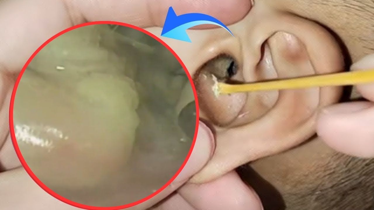 Soft & Satisfying Ear Cleaning | Deep Earwax Removal ASMR for ...