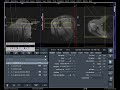 Mri planning shoulder