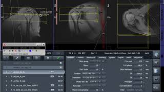 MRI planning Shoulder screenshot 3