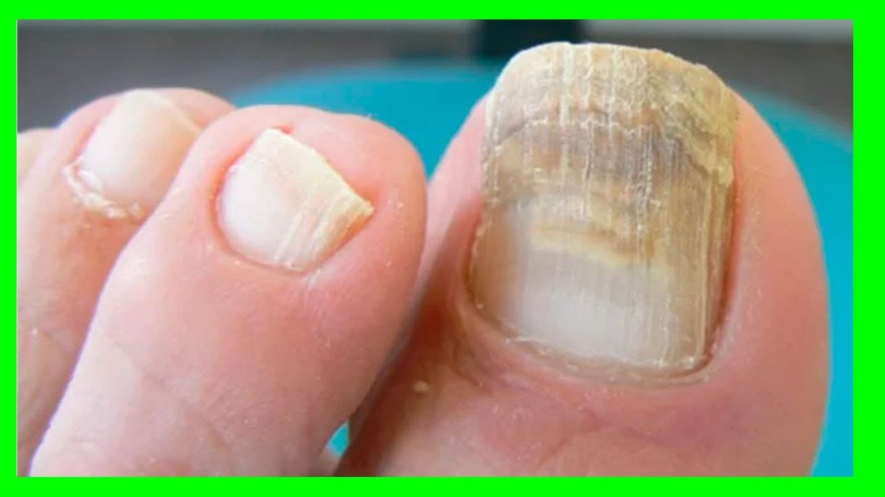 Prueba Este Remedio Para Desaparecer Los Hongos De Las U�as | Mejor Salud