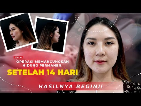 OPERASI MEMANCUNGKAN HIDUNG PERMANEN, SETELAH 14 HARI HASILNYA BEGINI! #PART4