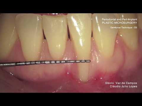 15 Cap 6 D3  Deminular Technique D3