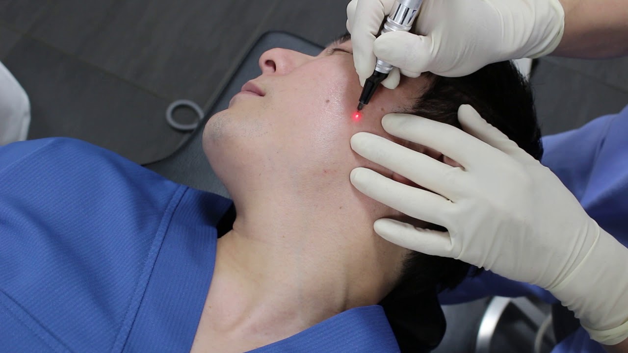 不潔な印象の男性のシミ イボは 専門医のレーザー治療で１回で除去できます １個５5００円 税込 １ミリあたり 美容整形 美容外科 船橋中央 青山セレスクリニック