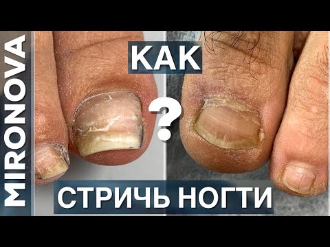 Как правильно стричь ногти на ногах?