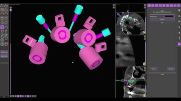 Stackable surgical guides design workwflow exampl