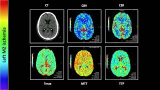 Perfusion Imaging Part 2 | Free Radiology CME