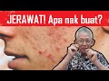 JERAWAT! Apa nak buat? 10 benda yang tak boleh diletak atas kulit muka