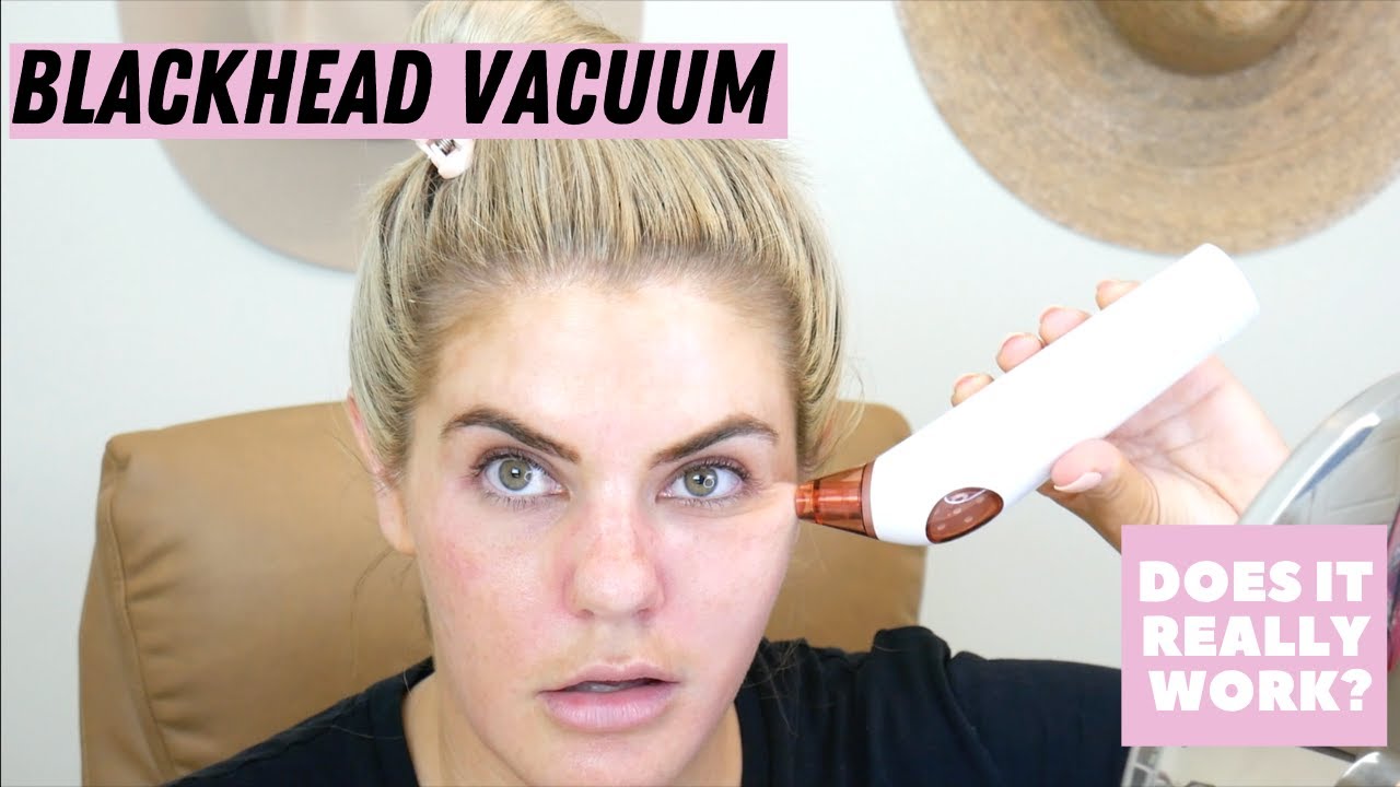 BLACKHEAD VACUUMS Do They Really Work? YouTube