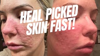 Fast Healing Skincare for Picked Skin | My Post-Picking Routine & Tips