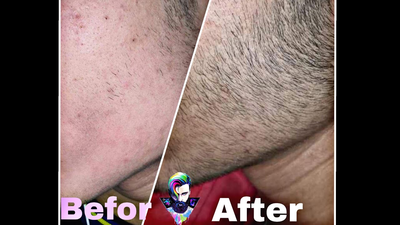 Minoxidil beard journey | Two months results🔥