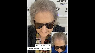 Density-Fill on Gray Hair - Scalp Micropigmentation