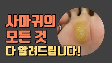 손 발 사마귀 (wart remove) 제거및 치료방법