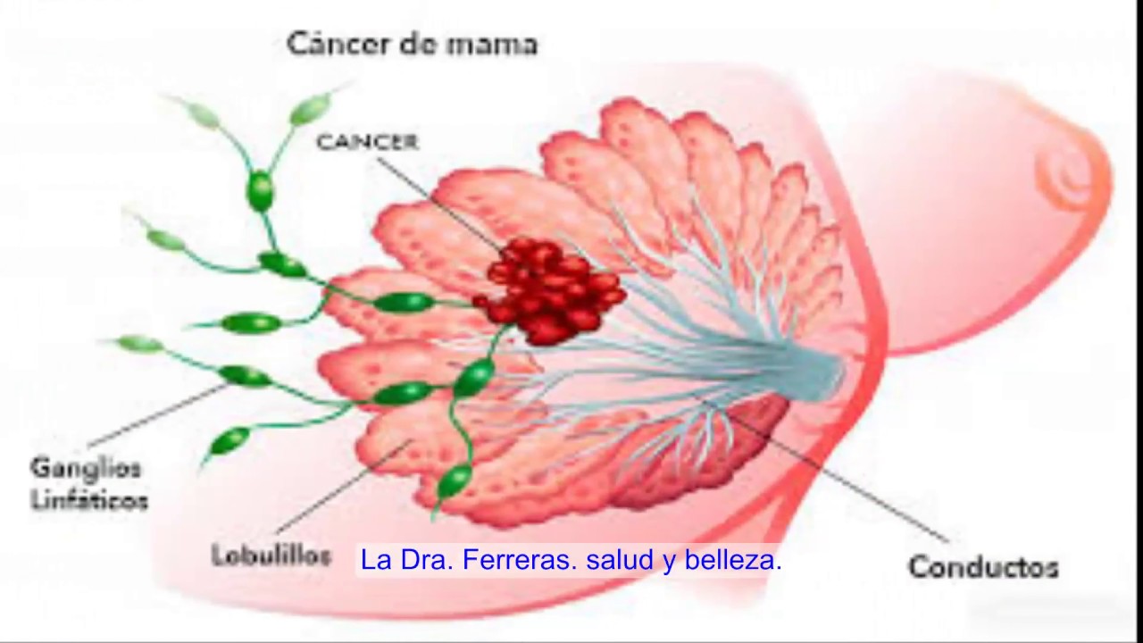 Alimentos prohibidos cáncer mama