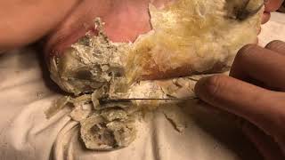 How To Removal Skin Callus Removal Skin Flakes 