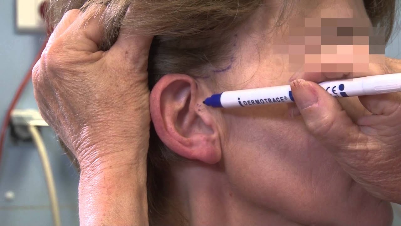 Lifting du Visage : Avant / Après