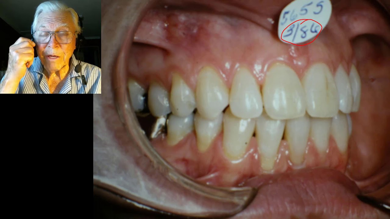 adult-tongue-thrust-treatment-youtube