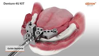 Denture 4U KIT | Osstem