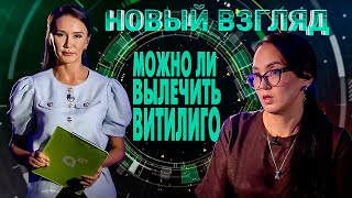 видео: Новый взгляд: можно ли вылечить витилиго? картинка: Новый взгляд: можно ли вылечить витилиго?